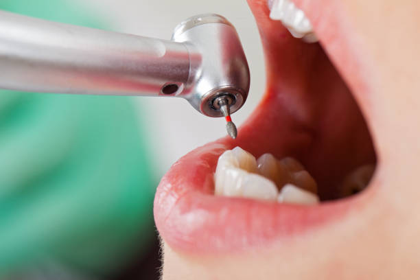 Best Emergency Tooth Extraction in Glen Carbon, IL